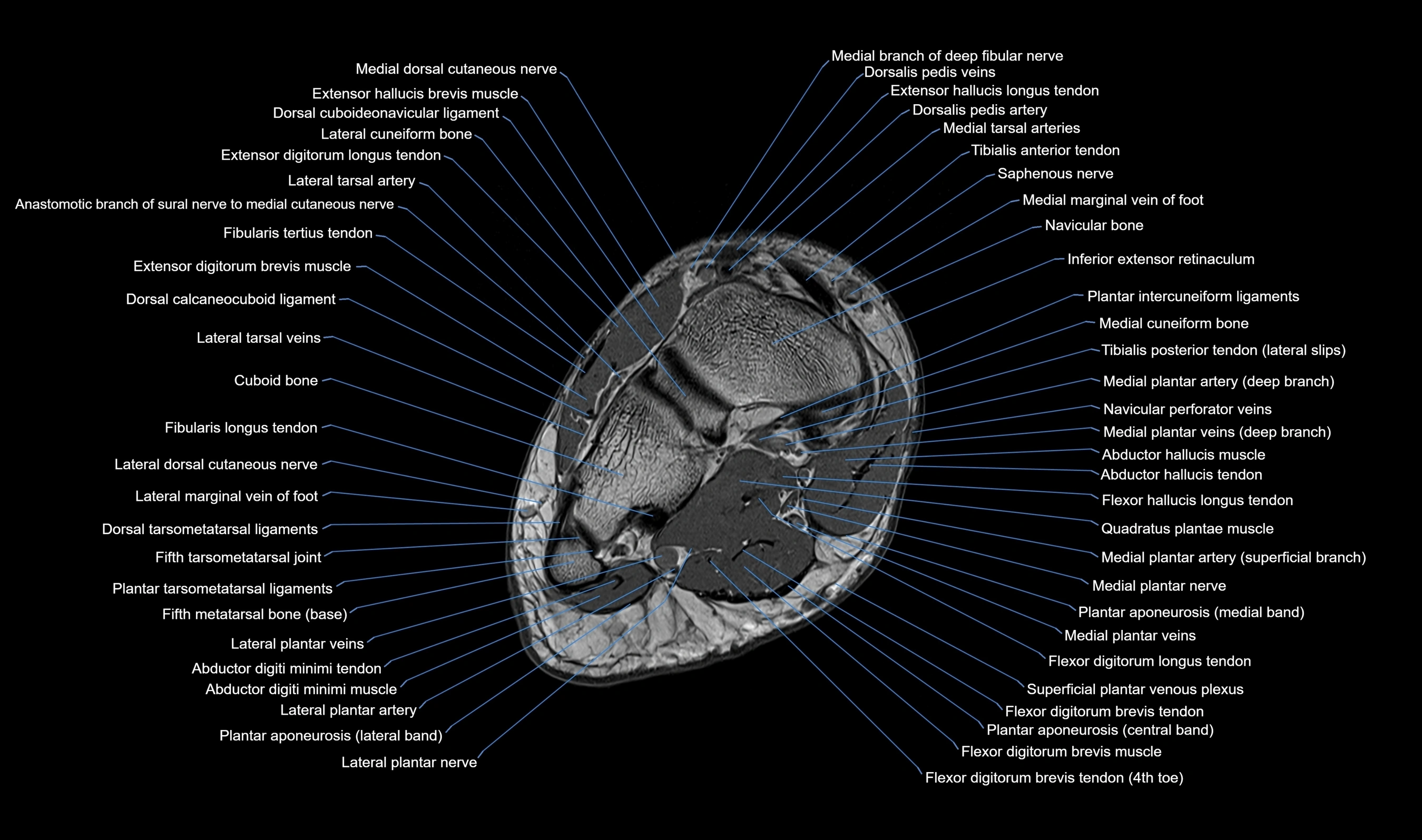 MRI mid foot axial cross sectional anatomy 3T  radiology  image-img-00001-00027.webp